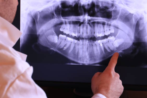 Best Emergency Wisdom Teeth Removal in Pahokee, FL
